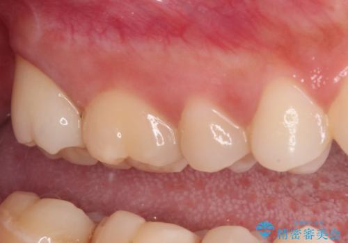 不快感が続く奥歯 外科処置を併用したセラミック補綴治療の治療後