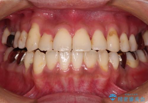 前歯のクロスバイトを改善　インビザライン矯正の治療中