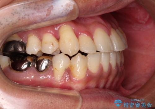 前歯のクロスバイトを改善　インビザライン矯正の治療中