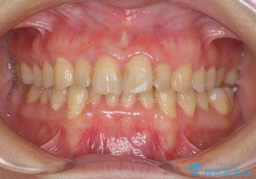前歯のデコボコと奥歯のクロスバイト　インビザラインで改善の症例 治療前
