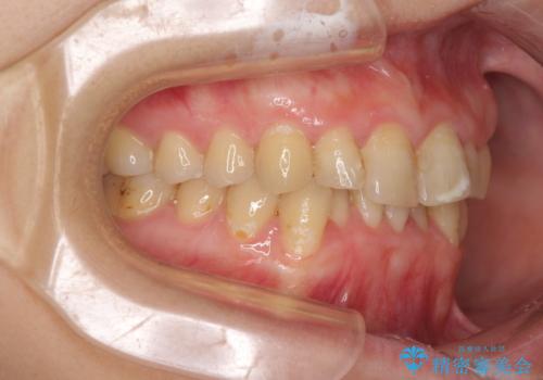 前歯のデコボコと奥歯のクロスバイト　インビザラインで改善の治療前