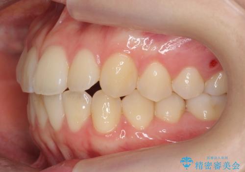 下の八重歯　歯を抜かずに　インビザライン治療の治療後