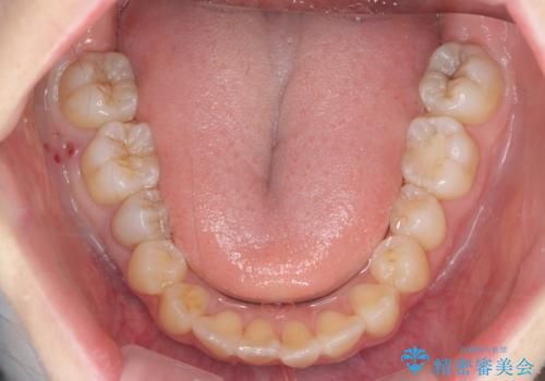 下の八重歯　歯を抜かずに　インビザライン治療の治療後
