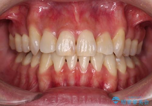 気になる八重歯を目立たない装置で改善　ハーフリンガル矯正の症例 治療後