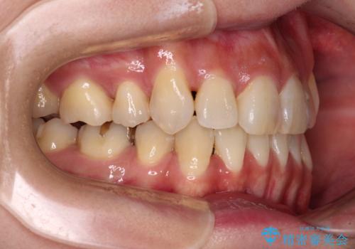 気になる八重歯を目立たない装置で改善　ハーフリンガル矯正の治療後
