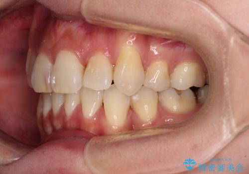 気になる八重歯を目立たない装置で改善　ハーフリンガル矯正の治療後