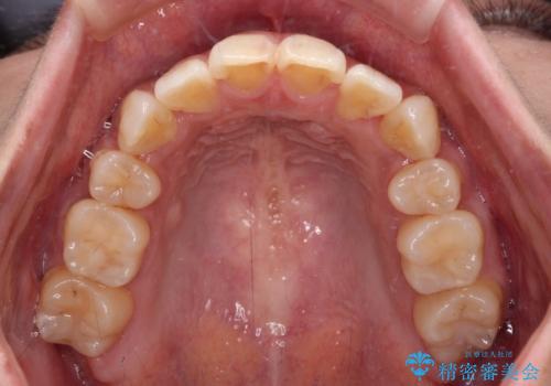 気になる八重歯を目立たない装置で改善　ハーフリンガル矯正の治療後