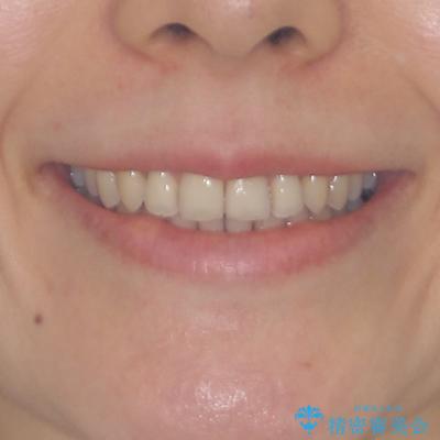 矯正治療の後戻り インビザライン・ライトによる矯正治療の治療後(顔貌)
