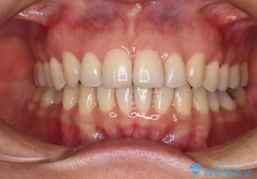 矯正治療の後戻り インビザライン・ライトによる矯正治療の症例 治療後