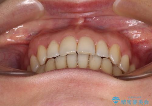 矯正治療の後戻り インビザライン・ライトによる矯正治療の治療後