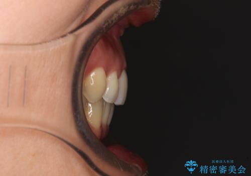 矯正治療の後戻り インビザライン・ライトによる矯正治療の治療後