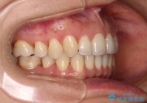 矯正治療の後戻り インビザライン・ライトによる矯正治療の治療後