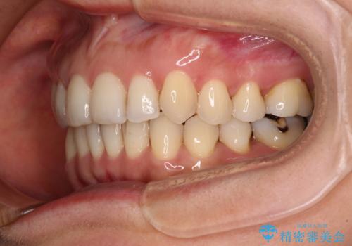 矯正治療の後戻り インビザライン・ライトによる矯正治療の治療後