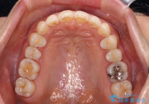 矯正治療の後戻り インビザライン・ライトによる矯正治療の治療後