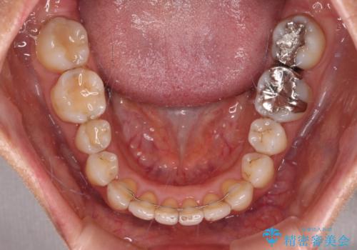 矯正治療の後戻り インビザライン・ライトによる矯正治療の治療後