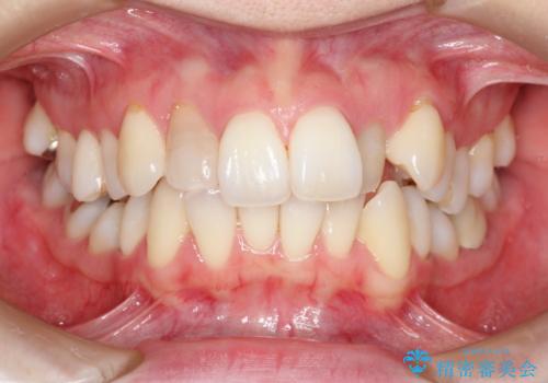 【ワイヤー矯正】歯のガタガタをなおしたいの治療前