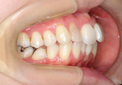 【ワイヤー矯正】歯のガタガタをなおしたいの治療前