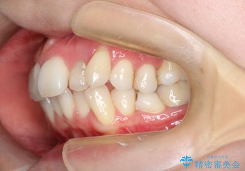 【ワイヤー矯正】歯のガタガタをなおしたいの治療前