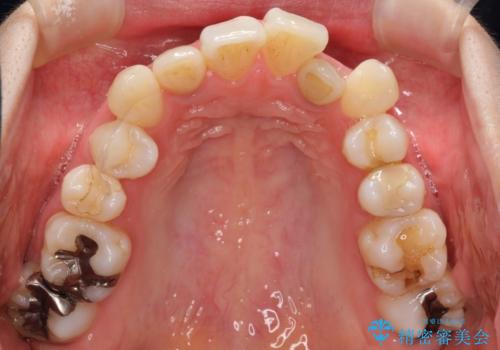 【ワイヤー矯正】歯のガタガタをなおしたいの治療前