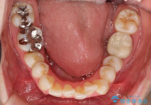 【ワイヤー矯正】歯のガタガタをなおしたいの治療前