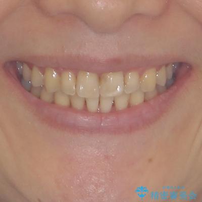 前歯のデコボコと奥歯のクロスバイト　インビザラインで改善の治療後（顔貌）