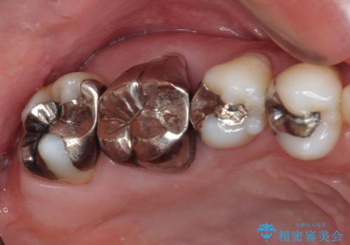 奥歯が痛い　セラミッククラウンでの虫歯治療の症例 治療前