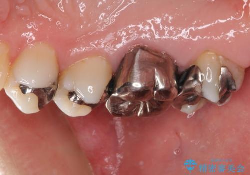 奥歯が痛い セラミッククラウンでの虫歯治療の治療前