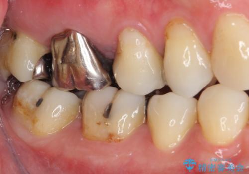 奥歯が痛い セラミッククラウンでの虫歯治療の治療前