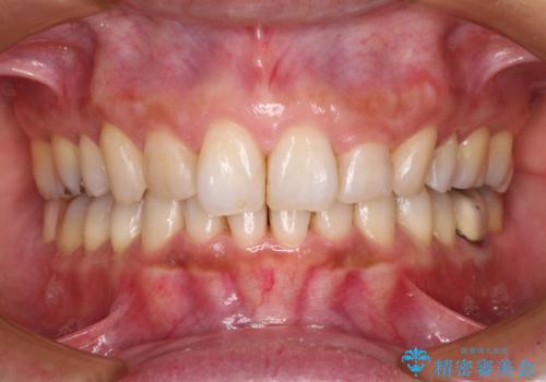 抜歯矯正の後戻りでできたスペース インビザライン矯正とセラミック治療の治療中