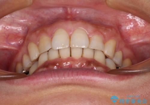 抜歯矯正の後戻りでできたスペース インビザライン矯正とセラミック治療の治療中