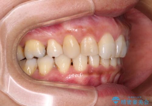 抜歯矯正の後戻りでできたスペース インビザライン矯正とセラミック治療の治療中