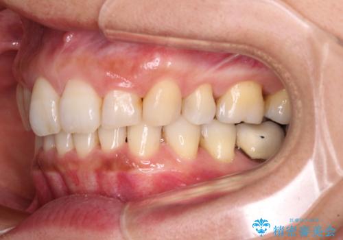 抜歯矯正の後戻りでできたスペース インビザライン矯正とセラミック治療の治療中