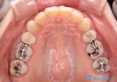 抜歯矯正の後戻りでできたスペース インビザライン矯正とセラミック治療の治療中
