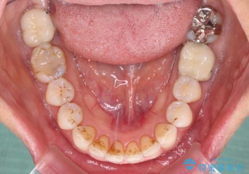 抜歯矯正の後戻りでできたスペース インビザライン矯正とセラミック治療の治療中