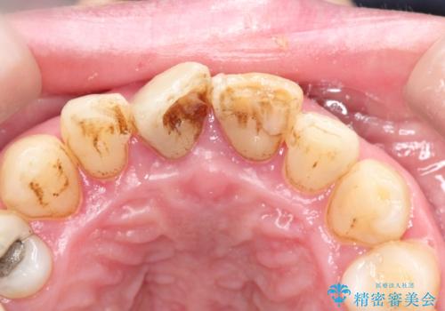 かけた前歯をきれいにしたいの治療前