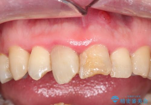 かけた前歯をきれいにしたいの治療前
