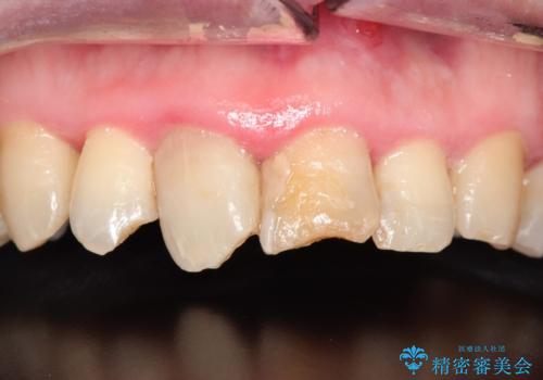 かけた前歯をきれいにしたいの治療前