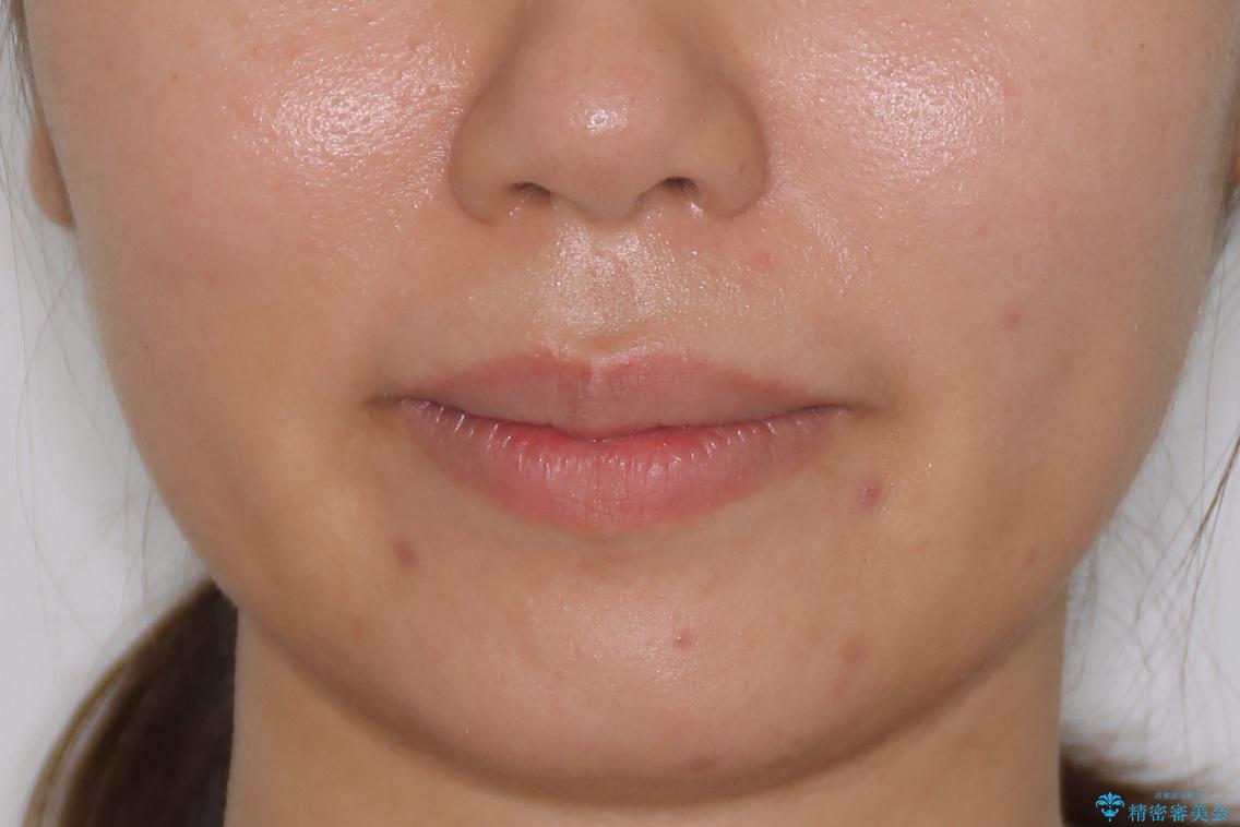 コンプレックスだった・・・唇が閉じなかった口元。綺麗になりました。の治療後(顔貌)