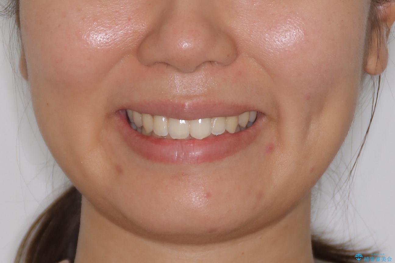 コンプレックスだった・・・唇が閉じなかった口元。綺麗になりました。の治療後(顔貌)