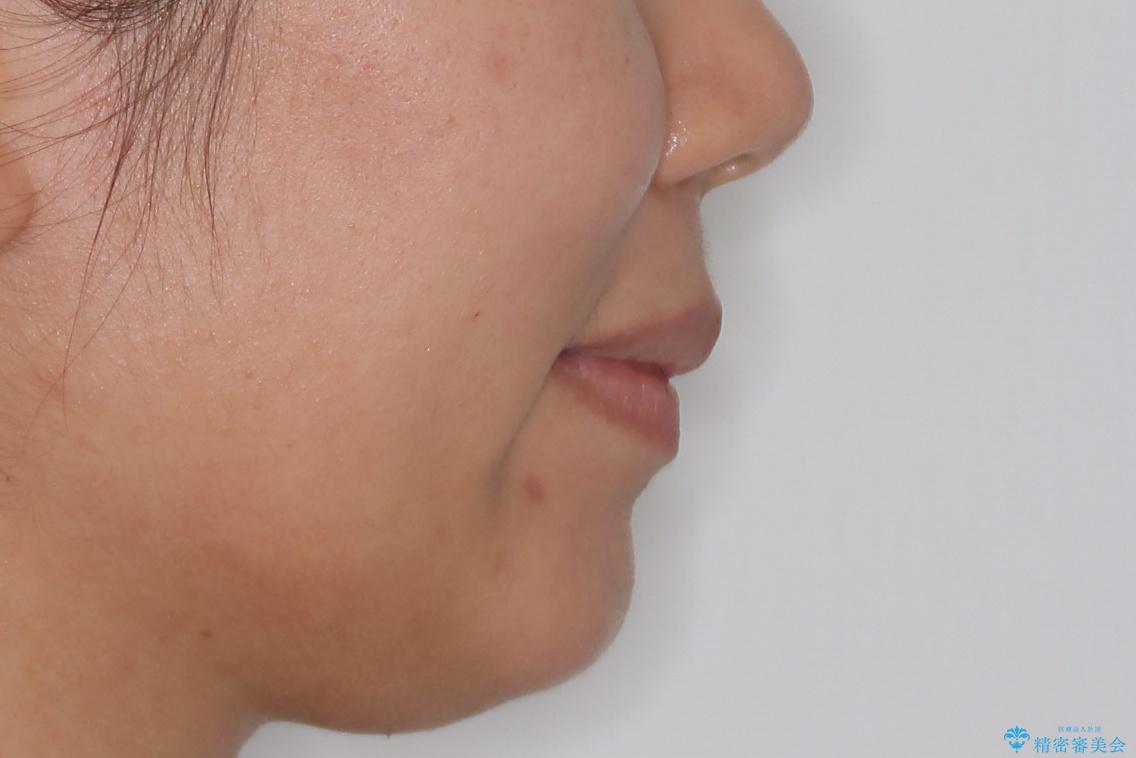 コンプレックスだった・・・唇が閉じなかった口元。綺麗になりました。の治療後(顔貌)