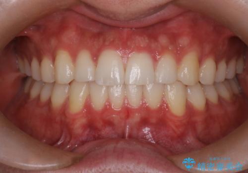 『目立たない装置で前歯のガタガタを治したい』インビザライン症例の症例 治療後