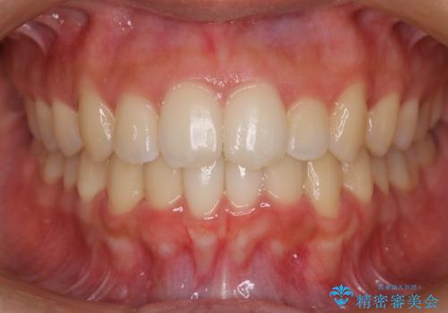 コンプレックスだった・・・唇が閉じなかった口元。綺麗になりました。の症例 治療後