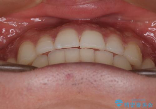 『目立たない装置で前歯のガタガタを治したい』インビザライン症例の治療後