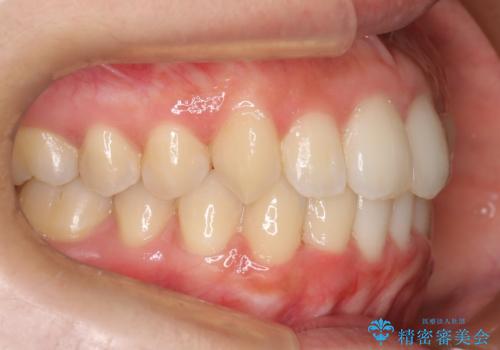 コンプレックスだった・・・唇が閉じなかった口元。綺麗になりました。の治療後