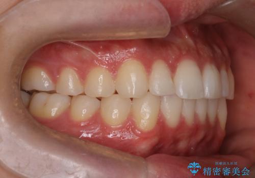 『目立たない装置で前歯のガタガタを治したい』インビザライン症例の治療後