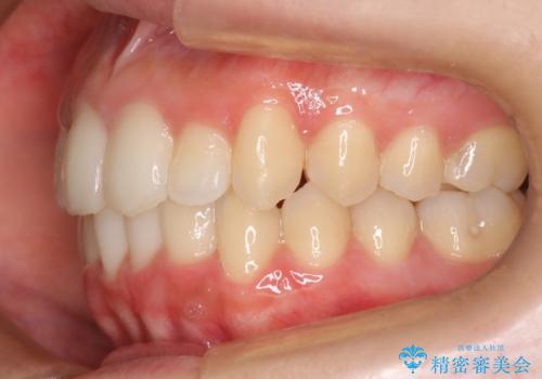 コンプレックスだった・・・唇が閉じなかった口元。綺麗になりました。の治療後