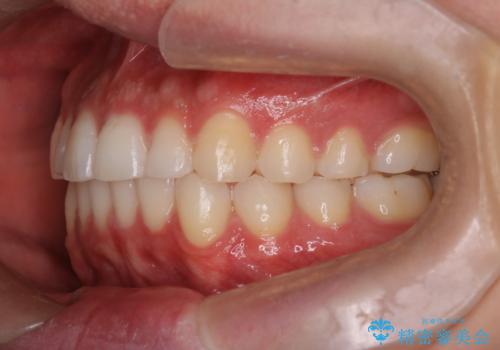 『目立たない装置で前歯のガタガタを治したい』インビザライン症例の治療後