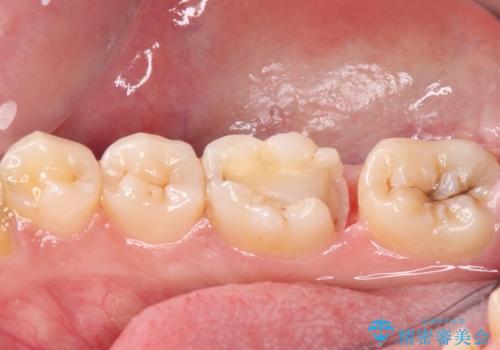 目立つ銀歯を白くしたい セラミック治療の治療中