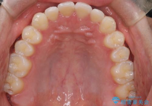 『目立たない装置で前歯のガタガタを治したい』インビザライン症例の治療後