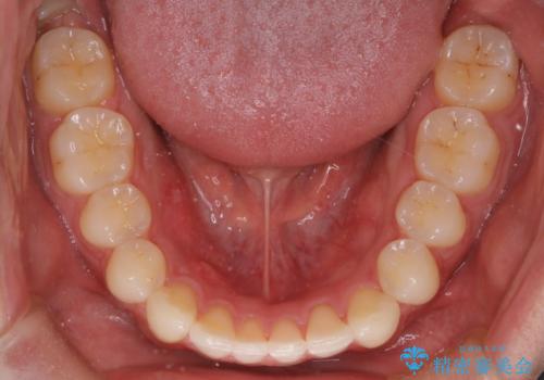 『目立たない装置で前歯のガタガタを治したい』インビザライン症例の治療後